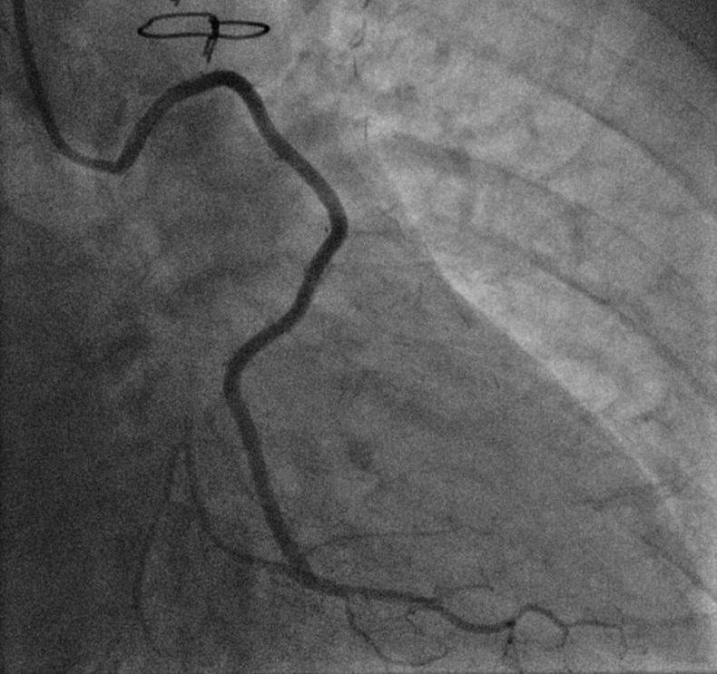 Coronary Artery Bypass Surgery