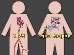 Transcatheter aortic valve replacement (TAVR)