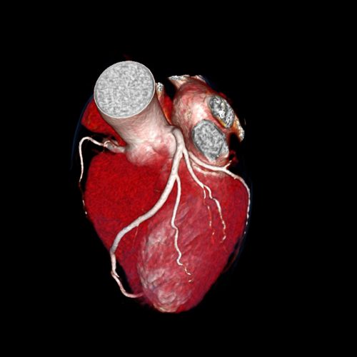 CT Coronary Angiogram and Calcium Score